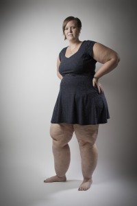 Elmie de Zwart heeft de ziekte lipodeem.